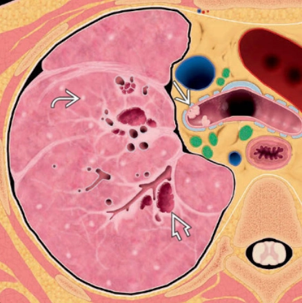 U nhú khí phế quản (Tracheobronchial Papillomatosis)