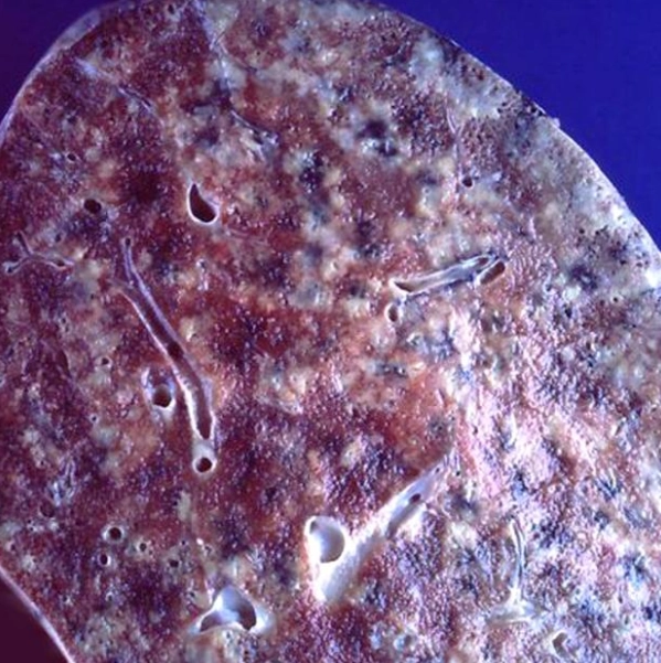 Lao gan lách (Hepatic and splenic tuberculosis)