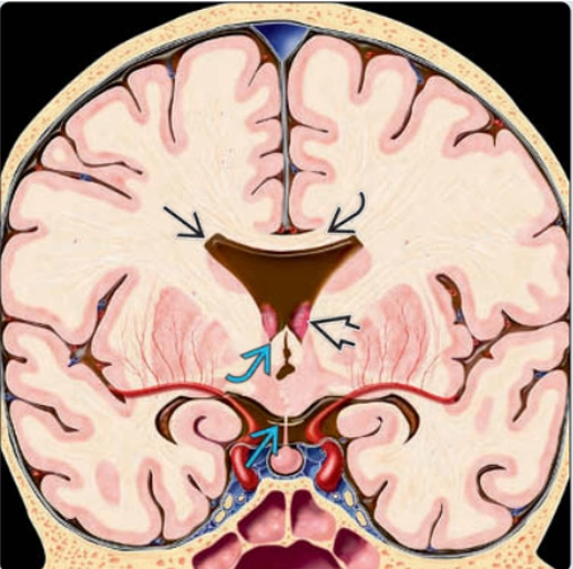 Loạn sản vách-thị thai nhi (Septo-optic dysplasia - SOD)