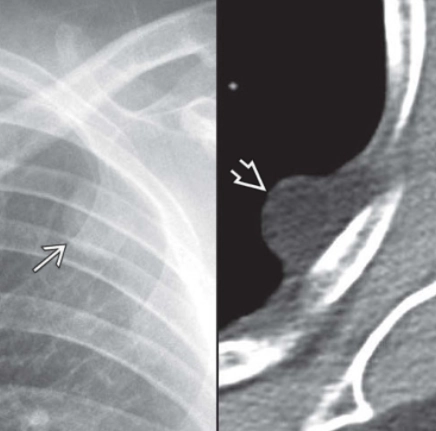 Dấu hiệu bờ không liên tục (phổi) -  Incomplete border sign (chest)