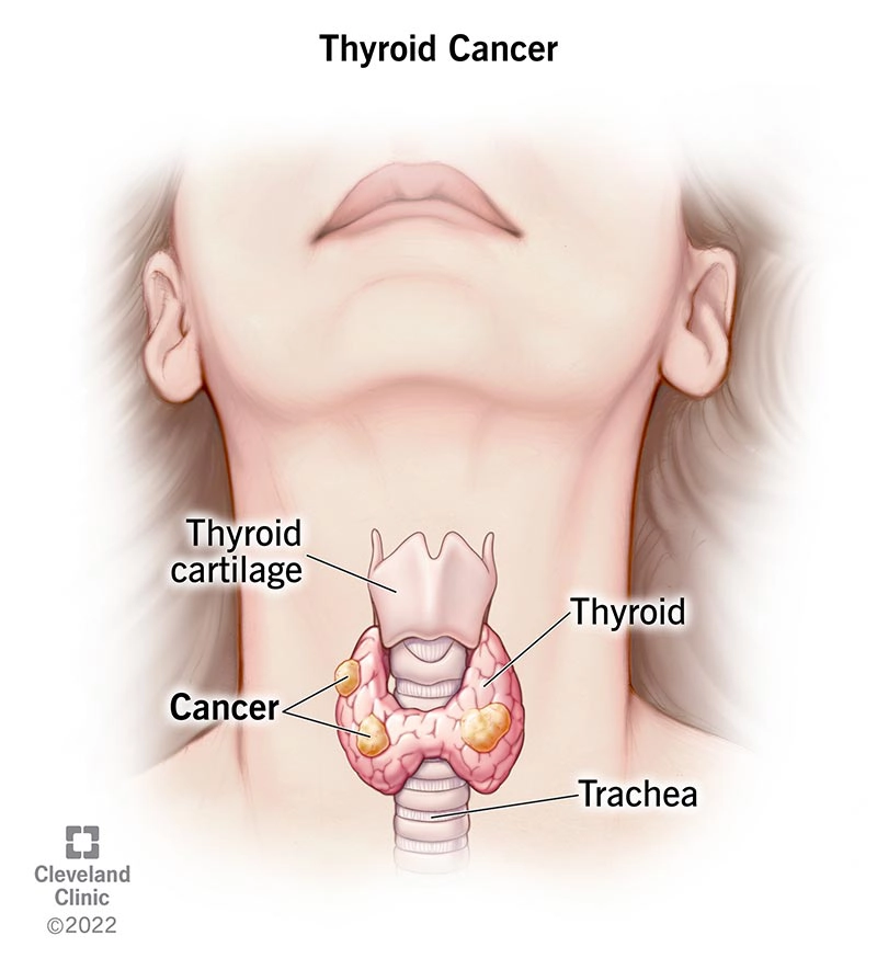 Lymphoma tuyến giáp (Thyroid lymphoma)