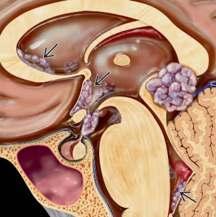 U mầm hệ thần kinh trung ương (Central Nervous System Germinoma)