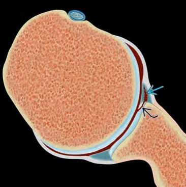 Tổn thương GLAD rách sụn viền-mặt khớp (Glenolabral Articular Disruption) 