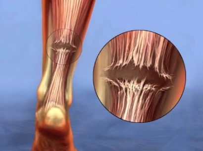 Đứt gân Achilles (Achilles tendon tear)
