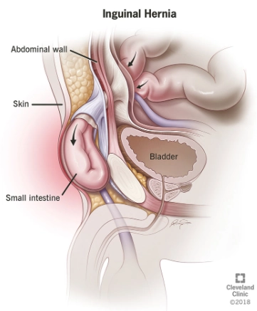 Thoát vị bẹn (Inguinal Hernia)