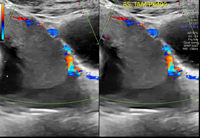Nhau tiền đạo (Placenta Previa) / Nhau bám thấp (Low-Lying Placenta)