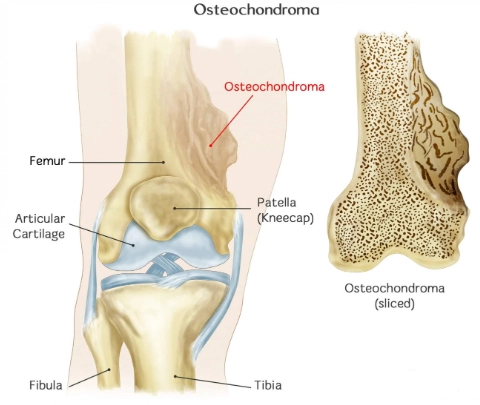 U xương sụn (Osteochondroma)