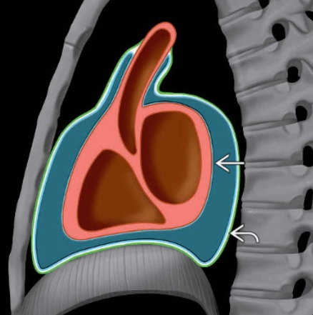 Tràn dịch màng ngoài tim (Pericardial Effusions)
