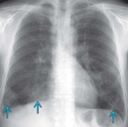 Bệnh bụi phổi do kim loại nặng (Hard Metal Pneumoconiosis)/Viêm phổi kẽ tế bào khổng lồ (Giant cell interstitial pneumonia - GIP)