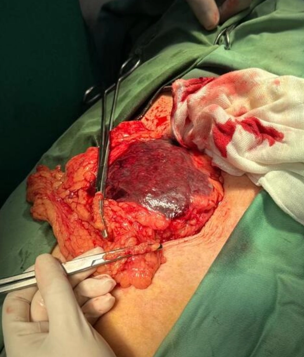 Nhồi máu mạc nối lớn (Omental Infarction)