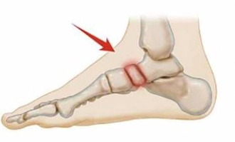 Hoại tử vô mạch xương ghe ở trẻ em (Köhler disease)