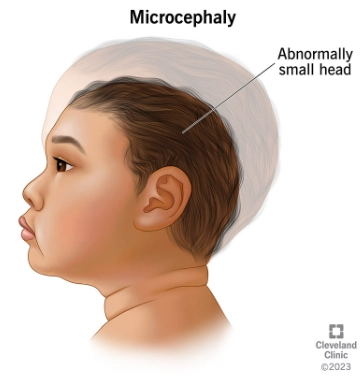 Đầu nhỏ (Microcephaly)