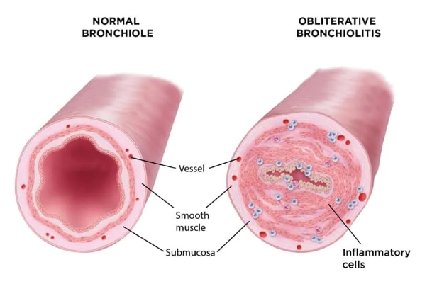 Viêm tiểu phế quản tắc nghẽn (Obliterative bronchiolitis)