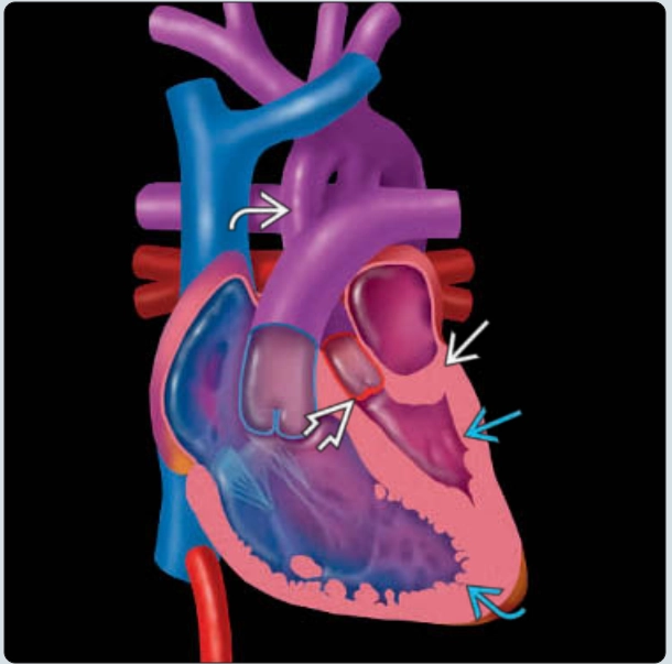Hội chứng thiểu sản tim trái (Hypoplastic Left Heart Syndrome)