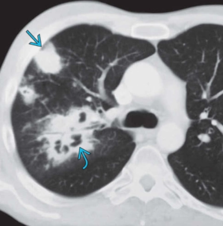 Nocardiosis phổi (Pulmonary Nocardiosis)/ Viêm phổi do Nocardiosis
