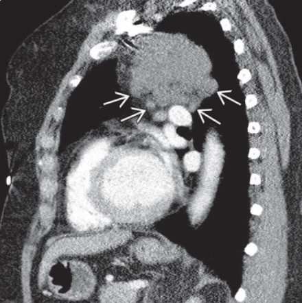 U mạch bạch huyết trung thất (Mediastinal Lymphangioma)