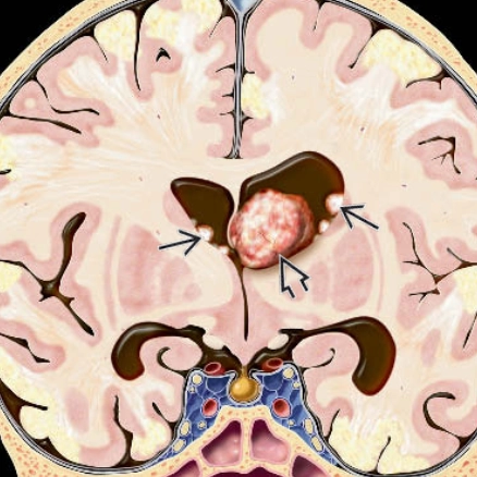 U sao bào khổng lồ dưới màng não thất (Subependymal Giant Cell Astrocytoma - SGCA/SEGA) 