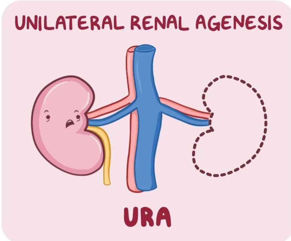 Bất sản thận một bên thai quý I (Unilateral renal agenesis)