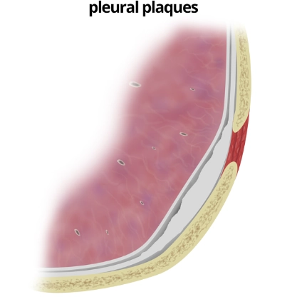 Mảng màng phổi (Pleural plaques)