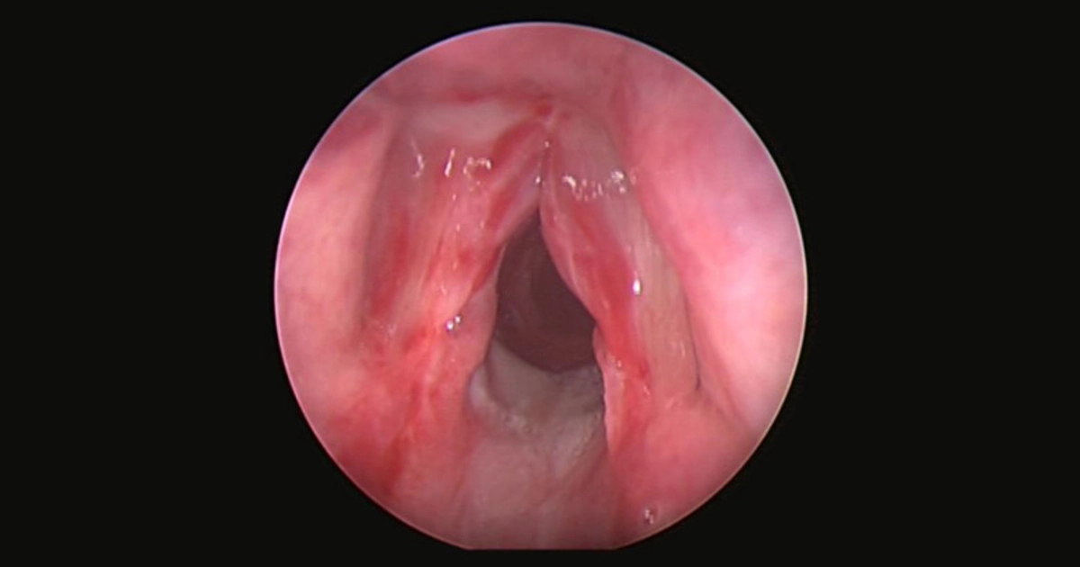 Chấn thương thanh quản (Laryngeal trauma)