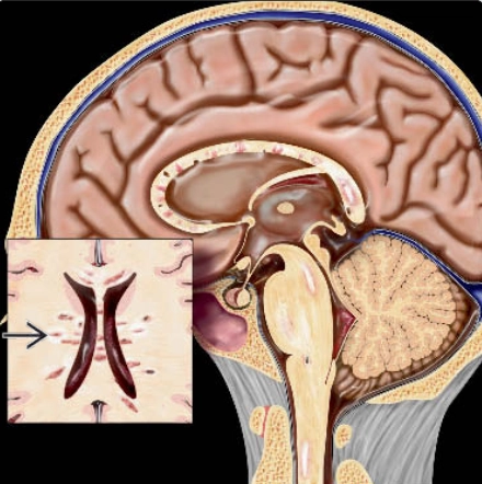 Bệnh xơ cứng rải rác (Multiple Sclerosis- MS)