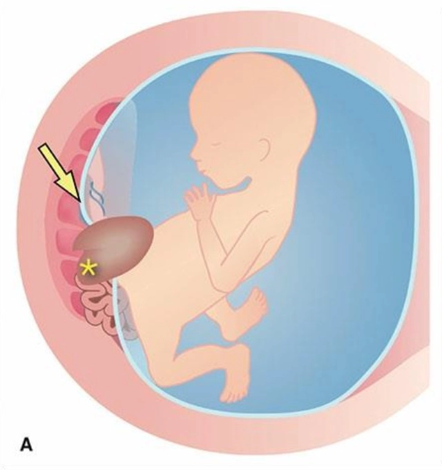 Bất thường phức hợp cơ thể (Body stalk anomaly)