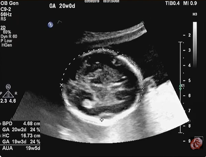 Tật mắt lồi thai nhi (Proptosis)