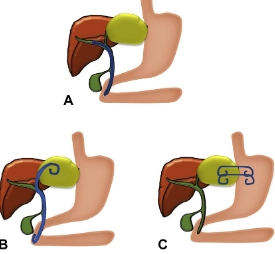 Ổ tụ mật (Biloma)