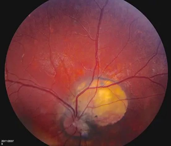 Hội chứng Aicardi (Aicardi syndrome)