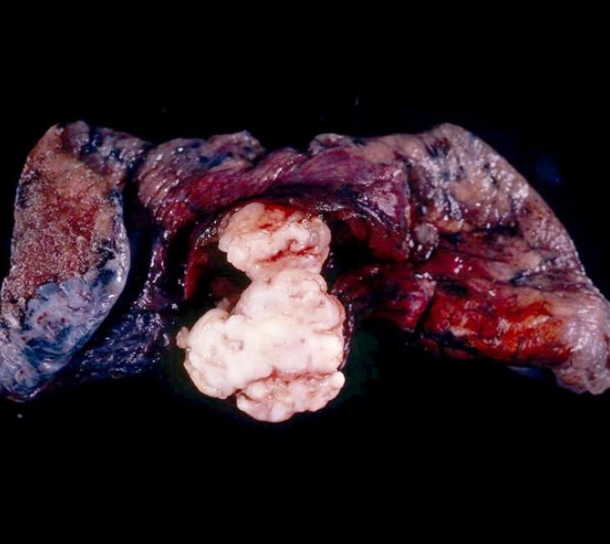 U mô thừa phổi (Pulmonary Hamartomas)