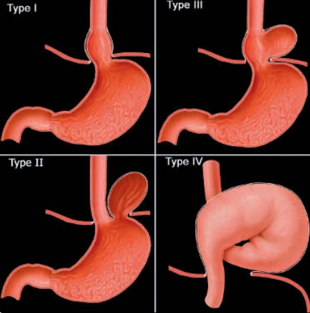 Thoát vị hoành (Hiatal Hernia)