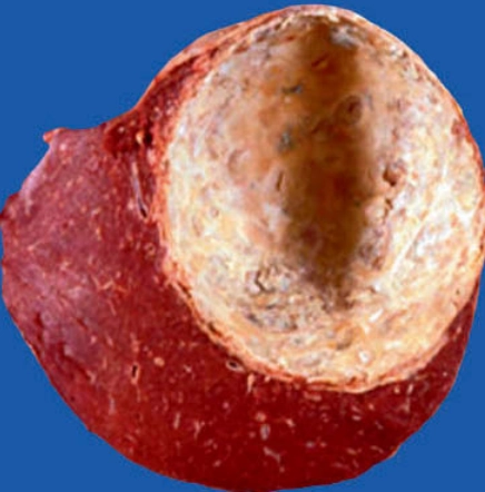 Nang lách (Splenic Cyst)