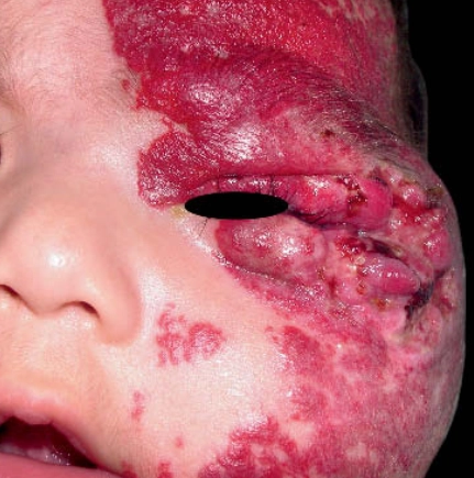 Hội chứng PHACE (Hội chứng u máu da - phức hợp mạch máu) - PHACES Syndrome