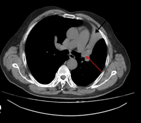Di căn đường thở (Metastasis Airways)