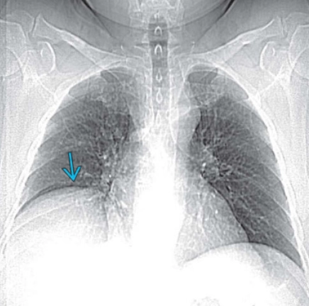 Liệt cơ hoành (Diaphragmatic Paralysis)(ngực)