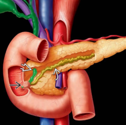 Ung thư bóng Vater (Ampullary Adenocarcinoma)