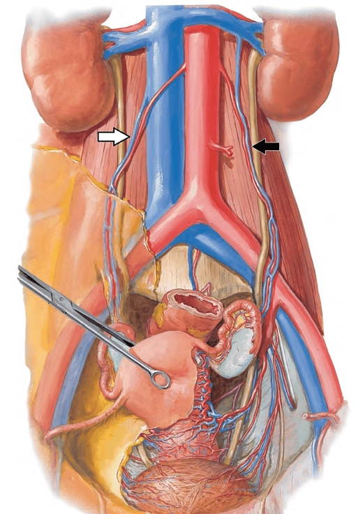 Huyết khối tĩnh mạch buồng trứng (Ovarian vein thrombosis)