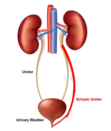 Niệu quản lạc chỗ (Ectopic ureter)