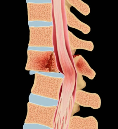 Gãy cột sống (Spinal Fracture)