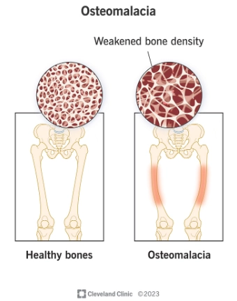 Bệnh nhuyễn xương (Osteomalacia)