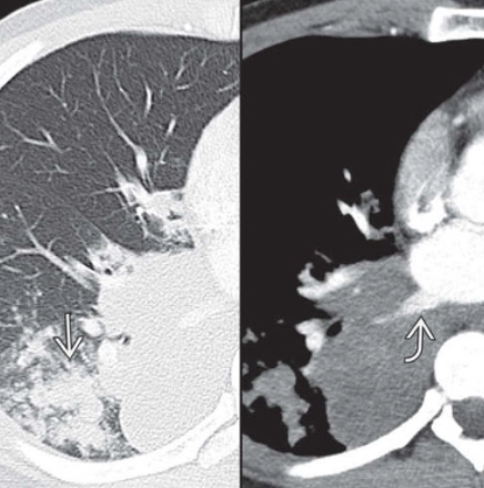 Viêm phổi do nấm Blastomyces