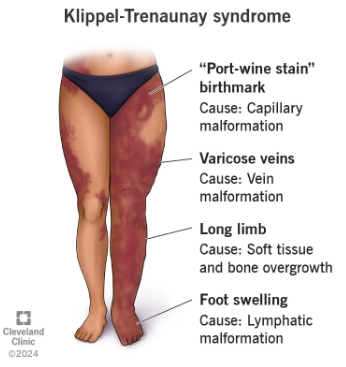 Hội chứng Klippel-Trénaunay (Klippel-Trénaunay syndrome)