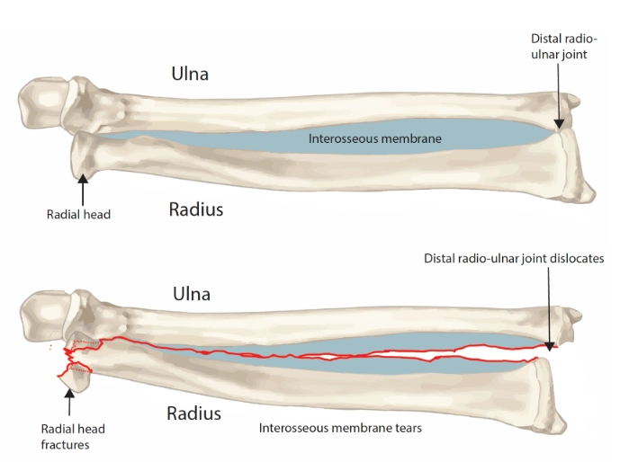Gãy-trật Essex-Lopresti (Essex-Lopresti fracture-dislocation)