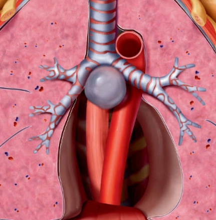 Nang phế quản (Bronchogenic cyst - BC)