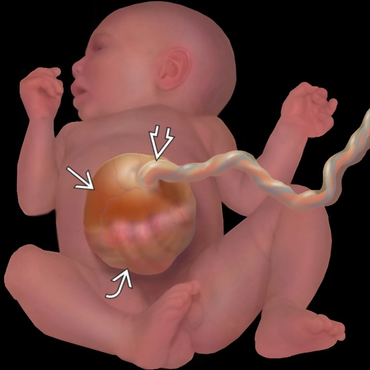 Thoát vị rốn thai nhi (Omphalocele)