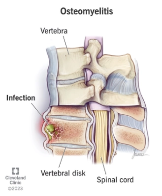Viêm xương tủy (Osteomyelitis)