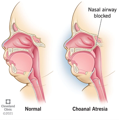 Tịt lỗ mũi sau (Choanal atresia)