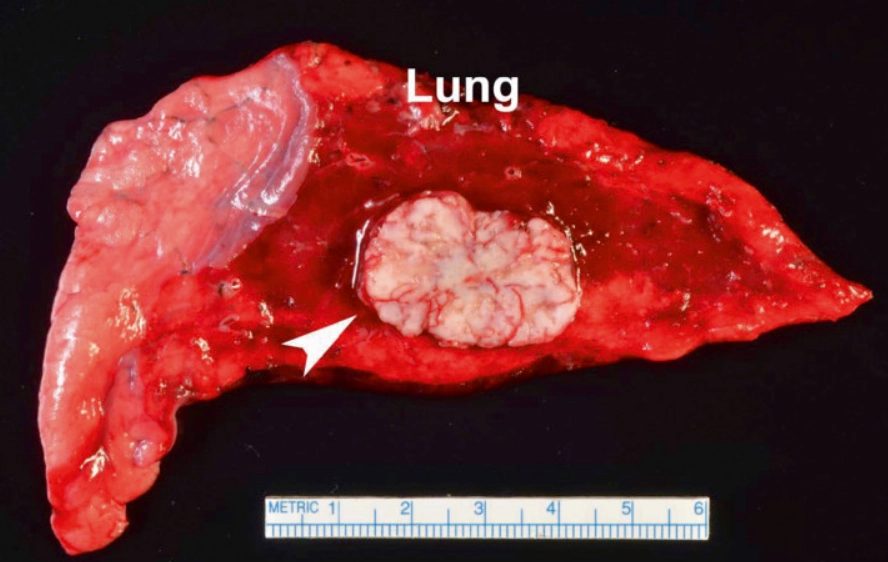 Nốt phổi đơn độc (Solitary pulmonary nodule - SPN)