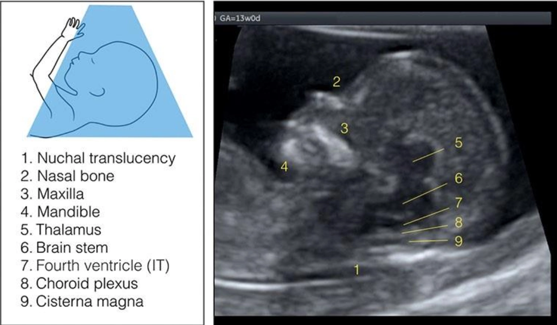 Giải phẫu bình thường hệ thần kinh trung ương thai quý I (Normal CNS anatomy in first trimester)