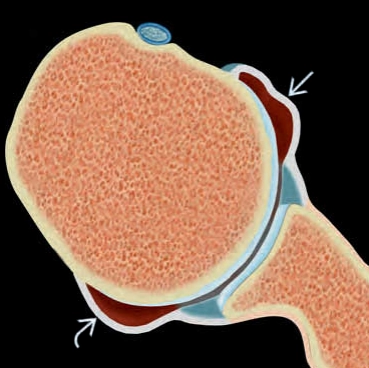 Mất vững khớp vai đa hướng (Multidirectional shoulder instability)
